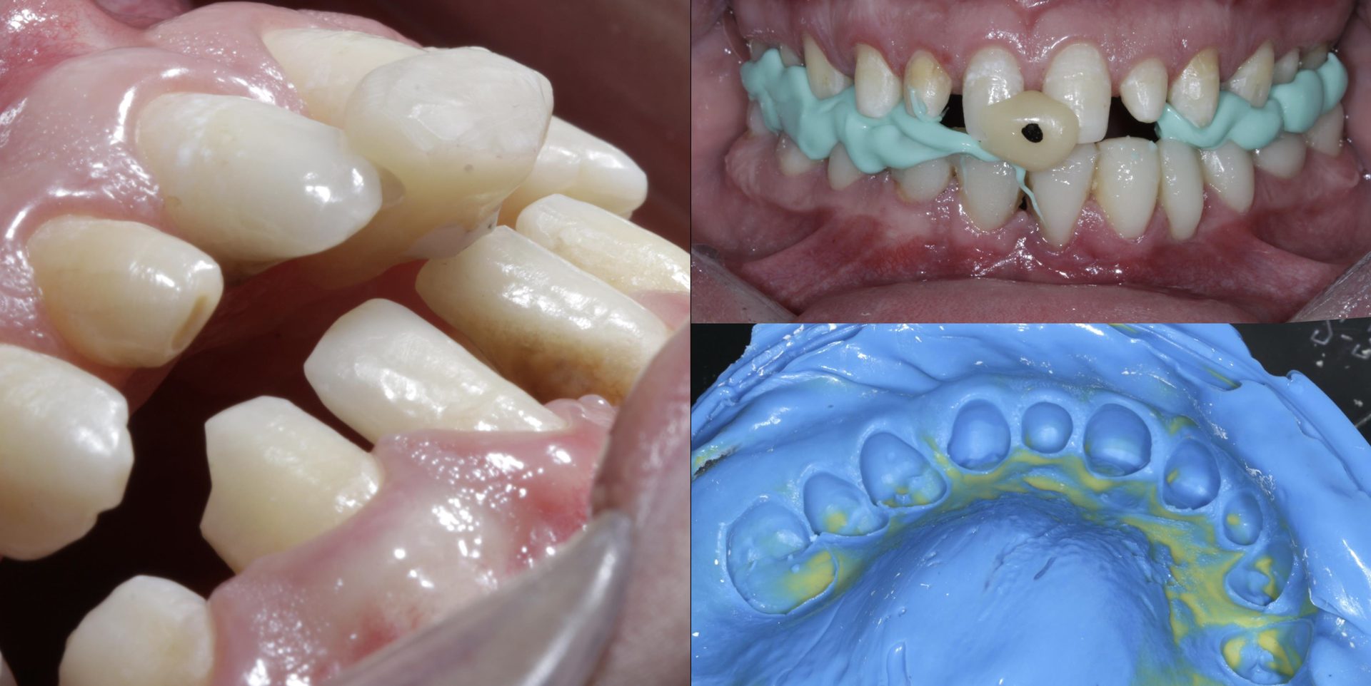 Antes e depois de caso clínico com aumento da dimensão vertical de oclusão