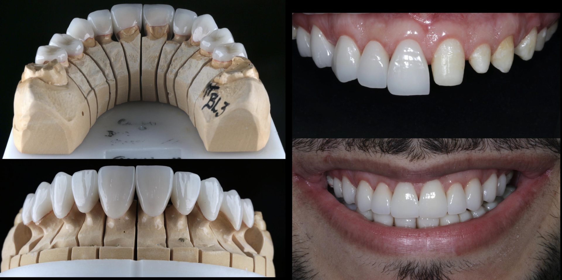 Resultado de odontologia estética com reabilitação oral adesiva