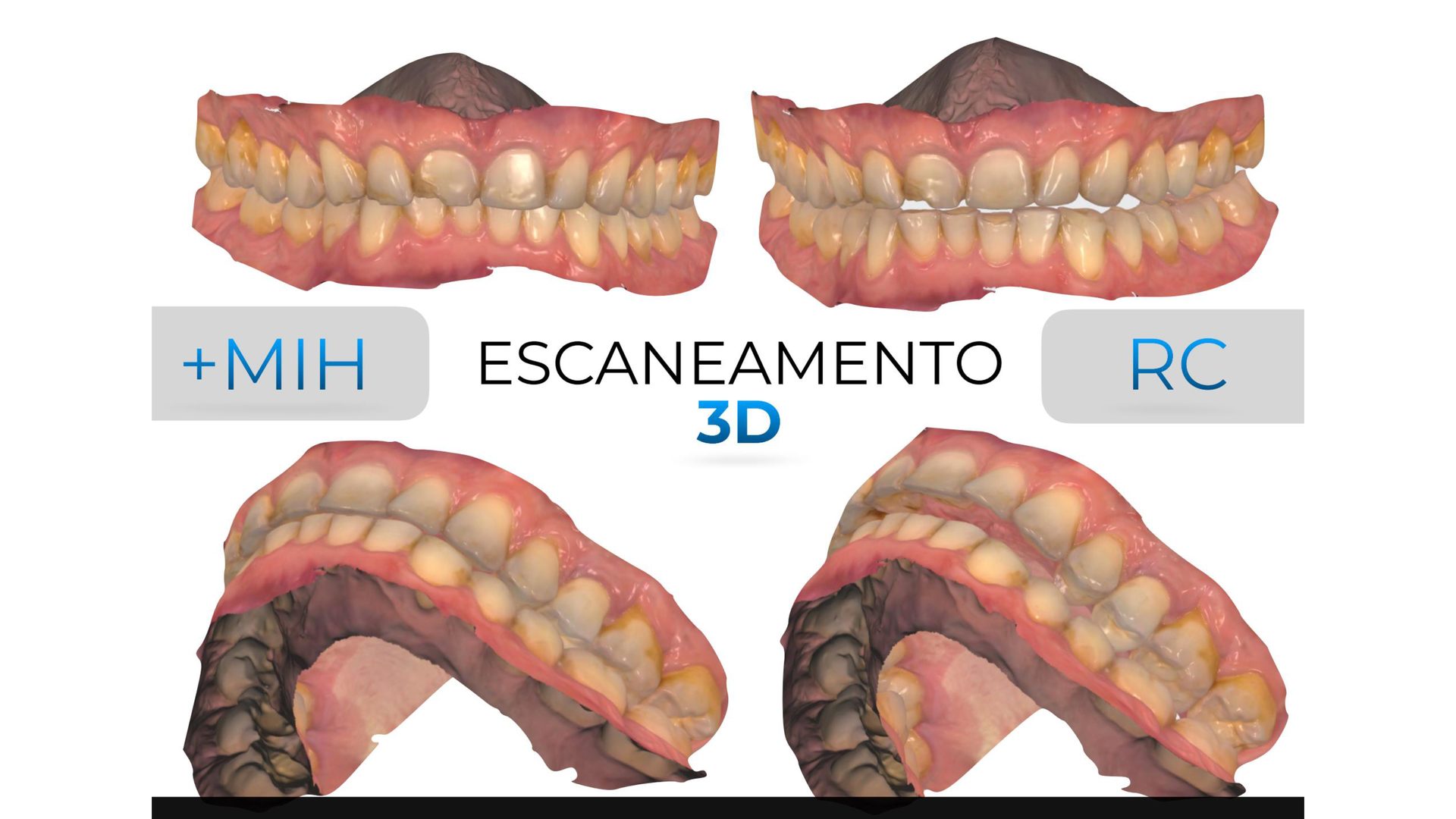 Caso clínico de reabilitação oral planejado em curso hands-on
