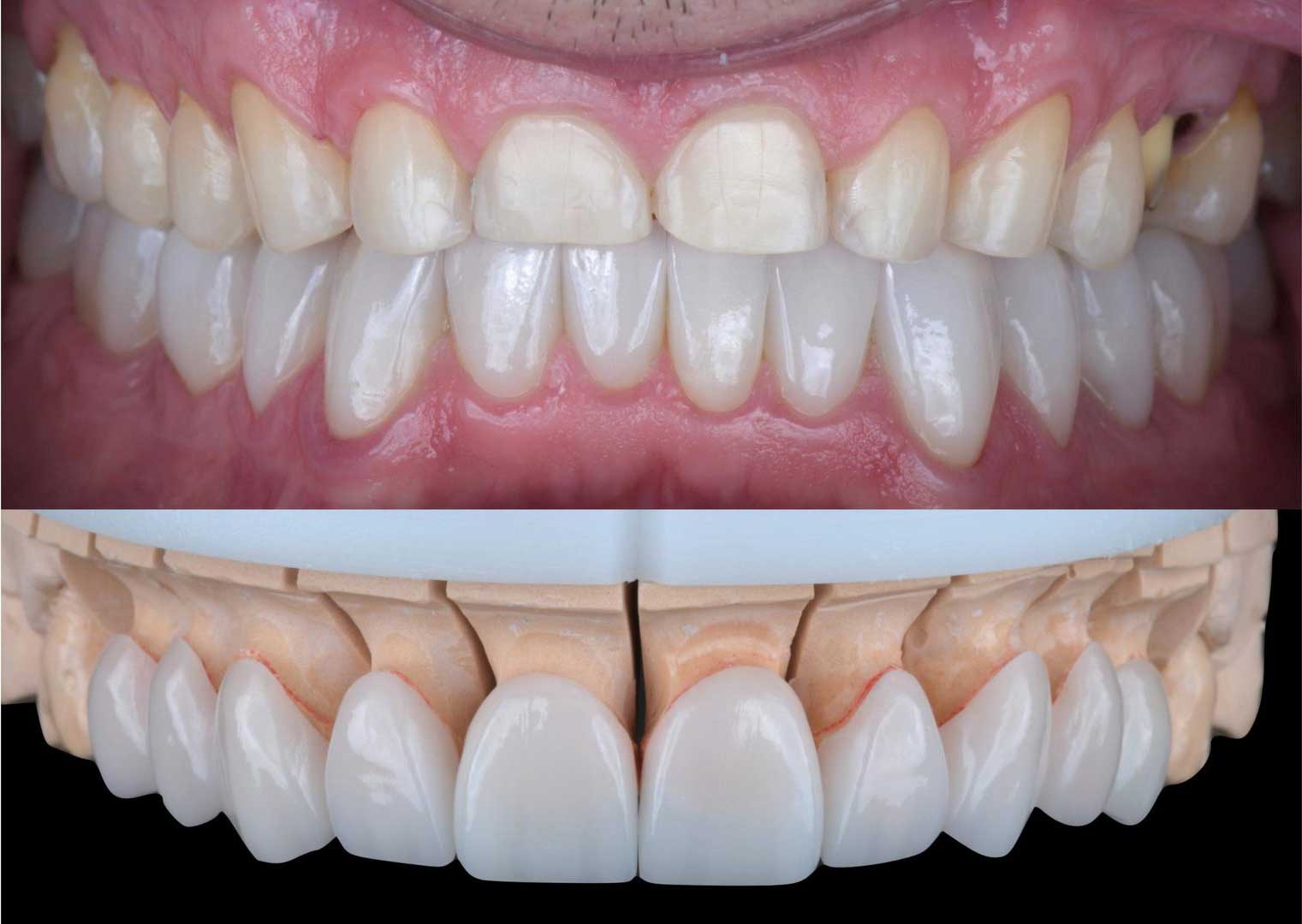 Caso clínico com planejamento oclusal e aumento da DVO
