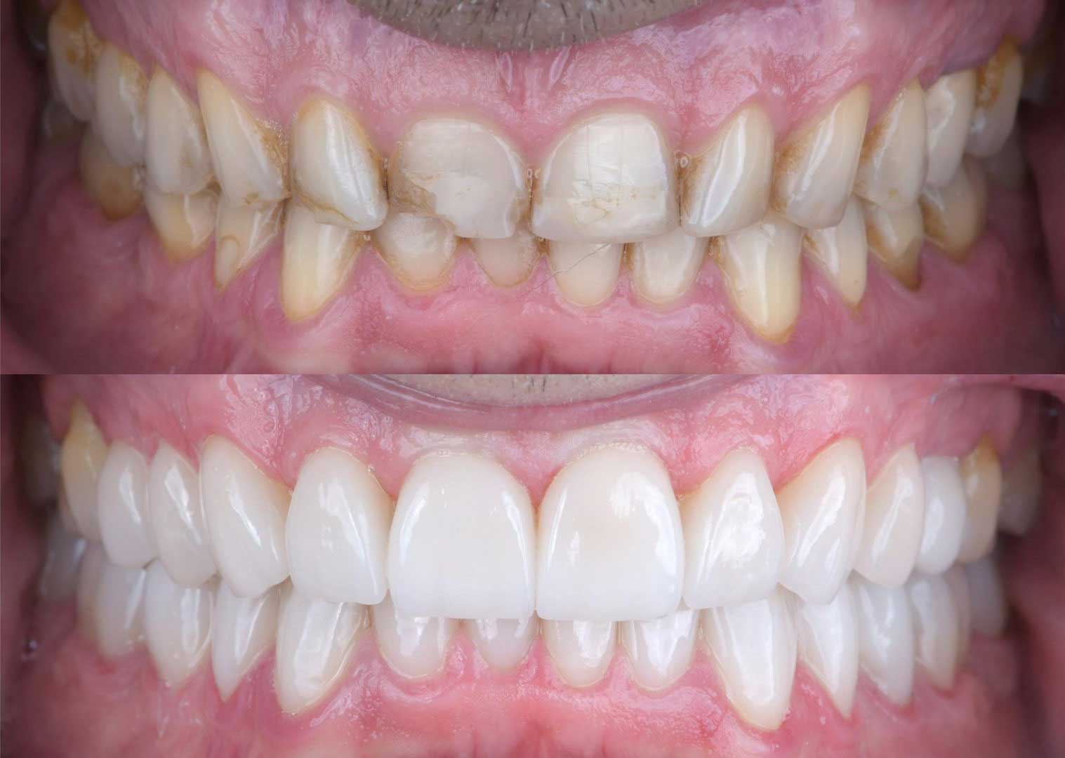 Resultado clínico de odontologia estética em reabilitação oral